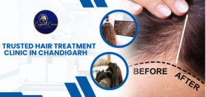 Hair Treatment Clinic in Chandigarh for Hair Regrowth and Hair Reduction