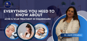 Everything You Need to Know About Acne & Scar Treatment in Chandigarh