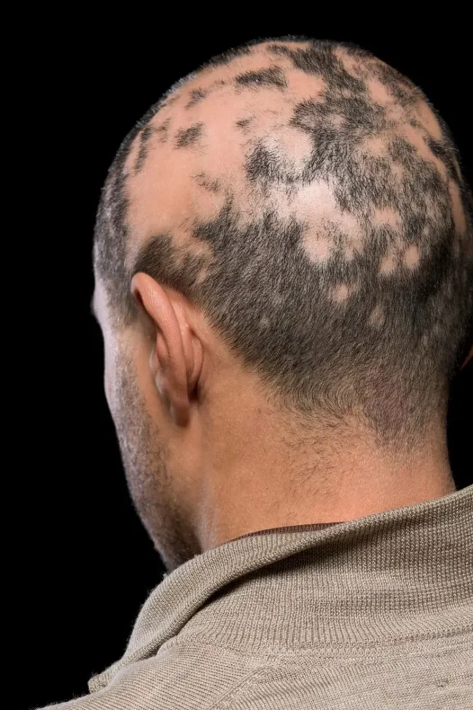 Alopecia