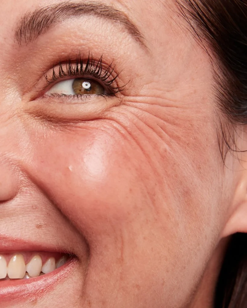 Fine lines and wrinkles