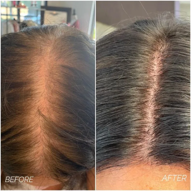 Hair Growth Treatment