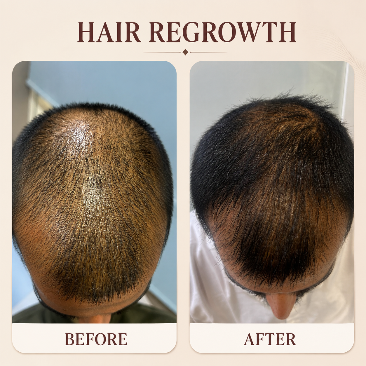 Hair Regrowth