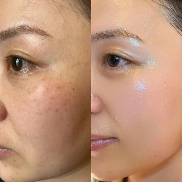 Hyrda Facial Chandigarh