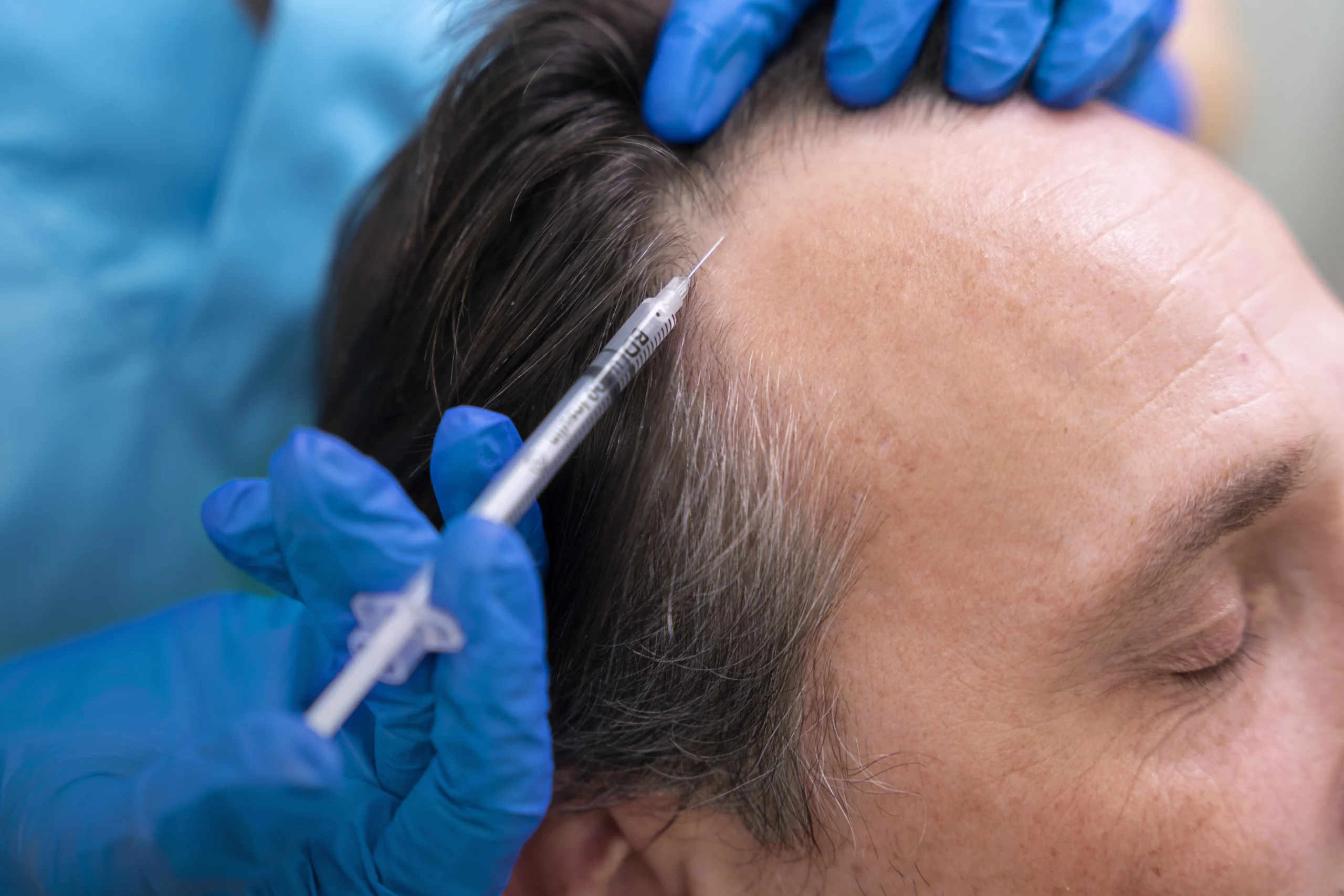 PRP Therapy