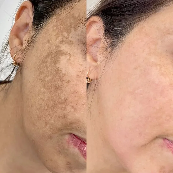 Pigmentation Chandigarh