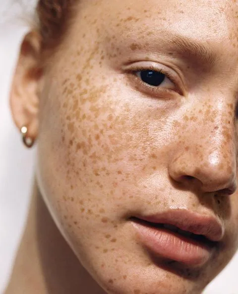 Skin pigmentation