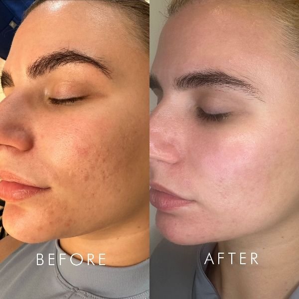 hydra treatment Chandigarh
